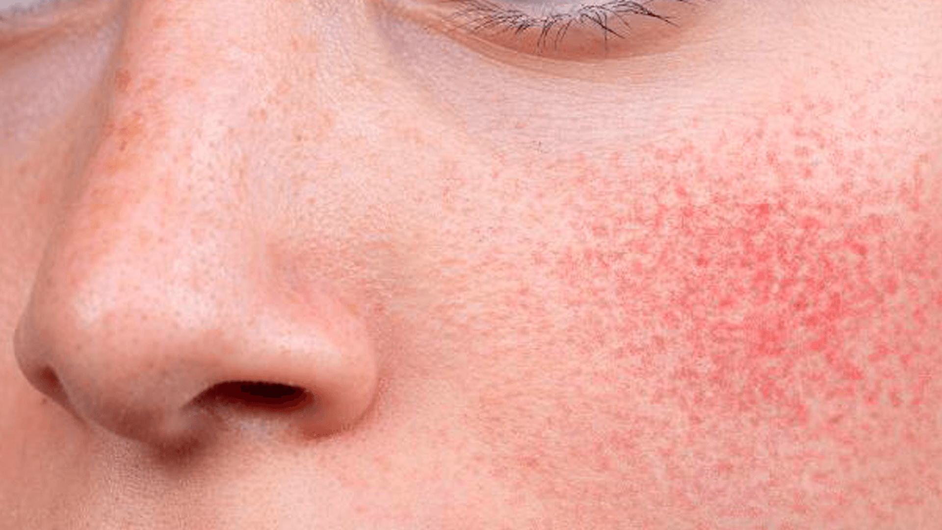 Soothe the Flame: A No-Fuss Guide to Calming Skin Inflammation