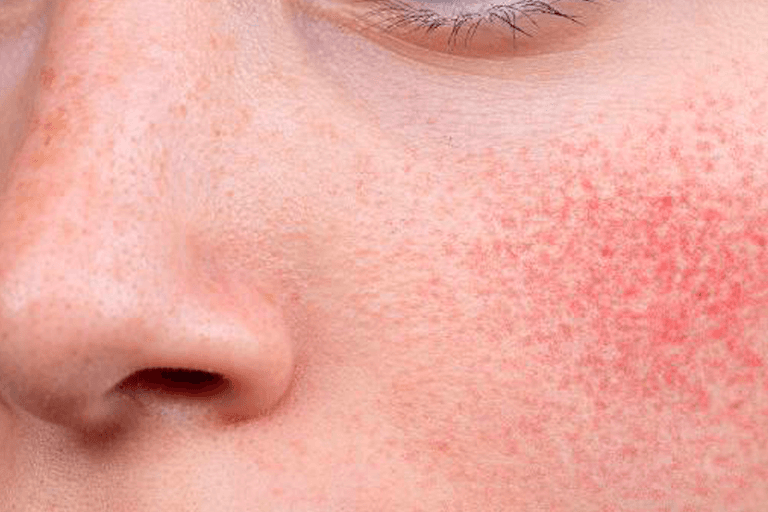 Soothe the Flame: A No-Fuss Guide to Calming Skin Inflammation